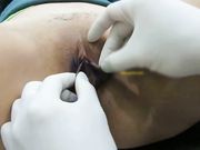 珍稀资源新加坡整形医学博士内部交流视频外阴唇切除巧变馒头逼